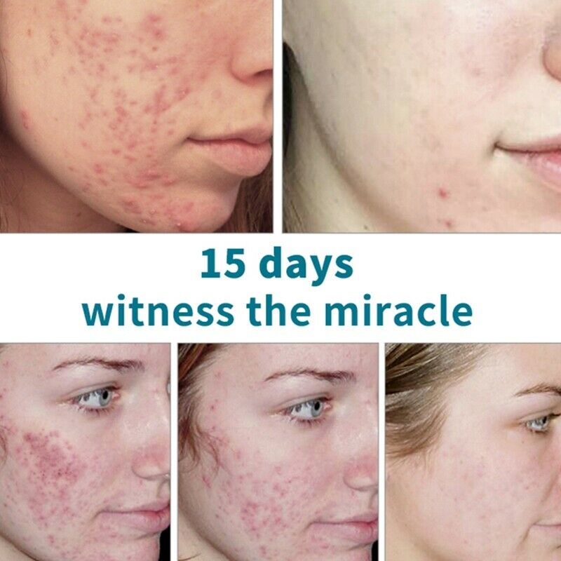 Hemeiel Shrink Pores Serum Acne Treatment Liquid Moisturizing Face Serum An T8W9