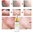 Vibrant Glamour Tea Tree Repair Face Serum Acne Scar Shrink Pores Face Seru I6N4