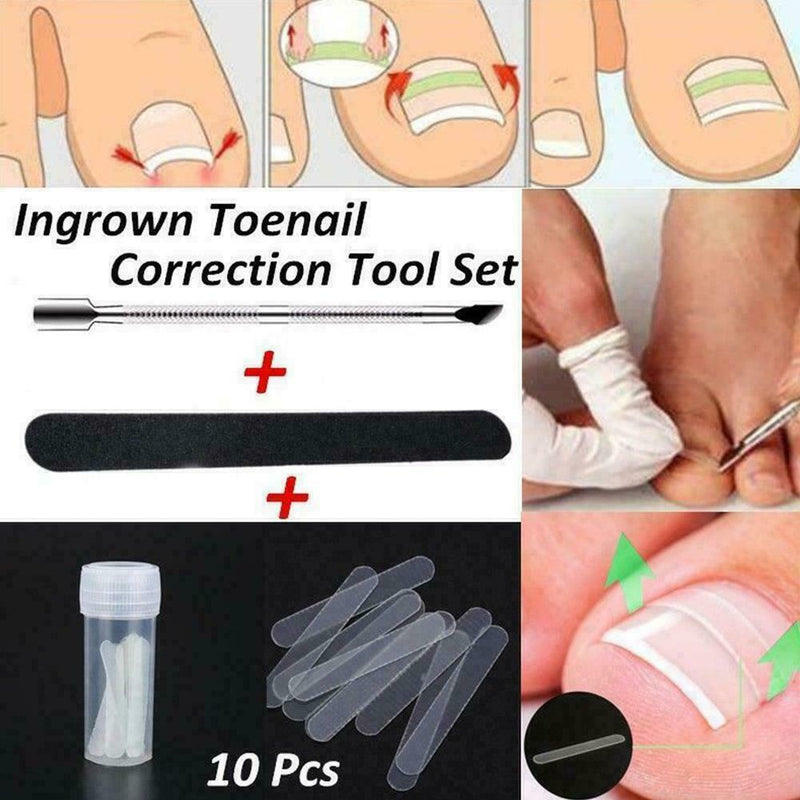 10Pcs Ingrown Toenail Straightening Clip Curved Brace Glue With Kit Correct F2V4