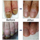 10ml Nail Repair Treatment Liquid Cleanser Onychomycosis Disinfect Water ne O7A1