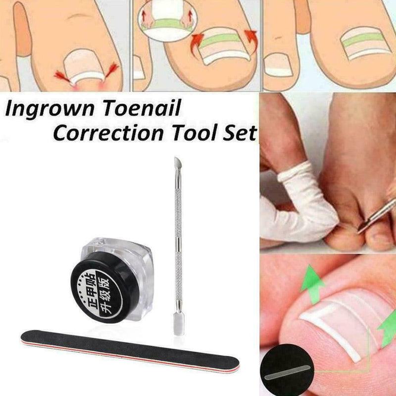 Ingrown Toenail Straightening Clip Glue Correction Curved Hot Brace Kit P3Y8
