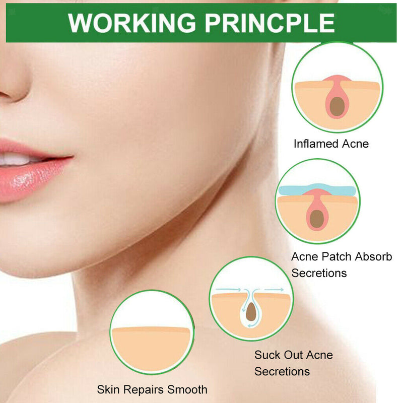 24Pcs Hydrocolloid Acne Remover Pimple Patch Stickers Tag Removal Invisible