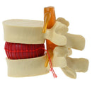 Anatomical Spine Lumbar Disc Herniation Anatomy Medical Teaching Tool