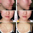 RtopR Propolis Repair Acne Brightening Serum Acne Scar Spots Cleaning Serum U2P3