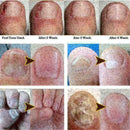 10ml Nail Repair Treatment Liquid Cleanser Onychomycosis Disinfect Water ne O7A1