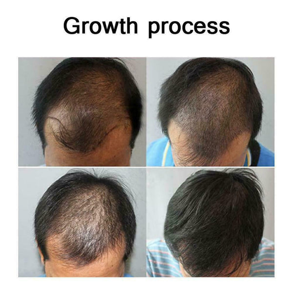 30ML Fast Hair Growth Ginger Liquid Hair Loss Treatment Care Hair E6R2