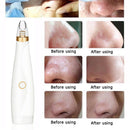 Pore Cleaner Blackhead Remover Vacuum Black Dots Pimples Removal Skin Care