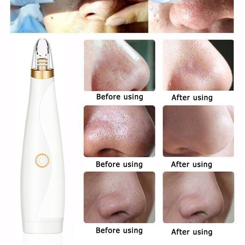 Pore Cleaner Blackhead Remover Vacuum Black Dots Pimples Removal Skin Care