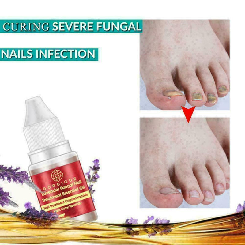 Nail Treatment Essential Oil Nail Nourishing Brightening Promote Nails Foot Y2J3