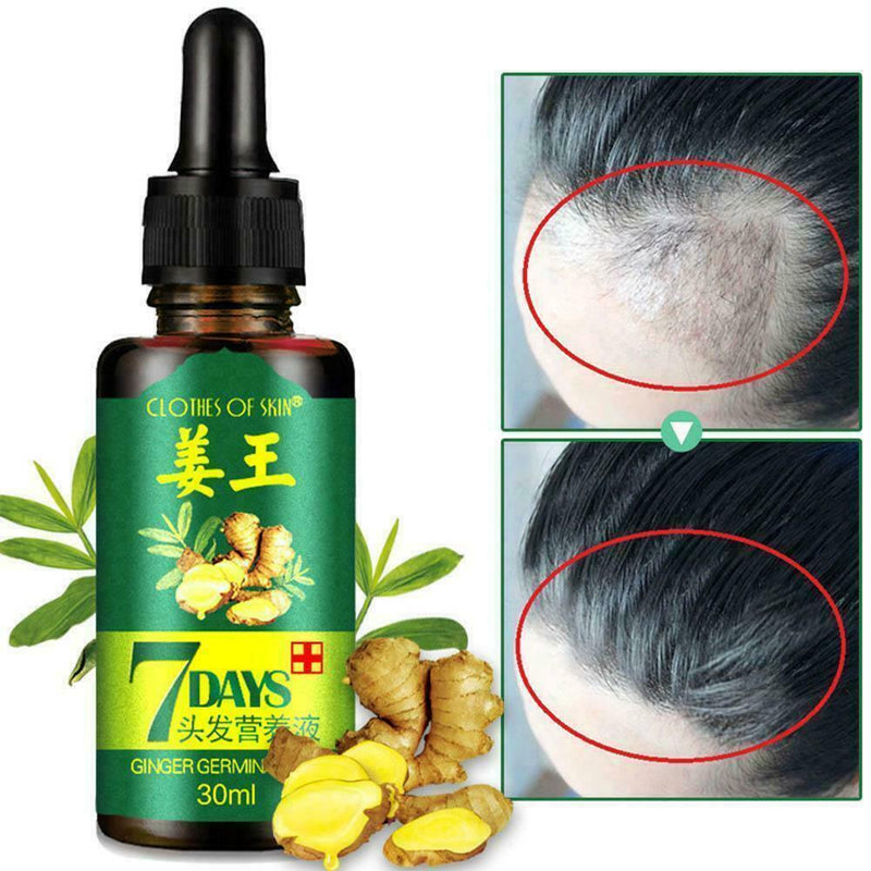 30ml Extract Hair Growth Essence Oil Anti Hair Loss Fast Restoration Growth X9H6