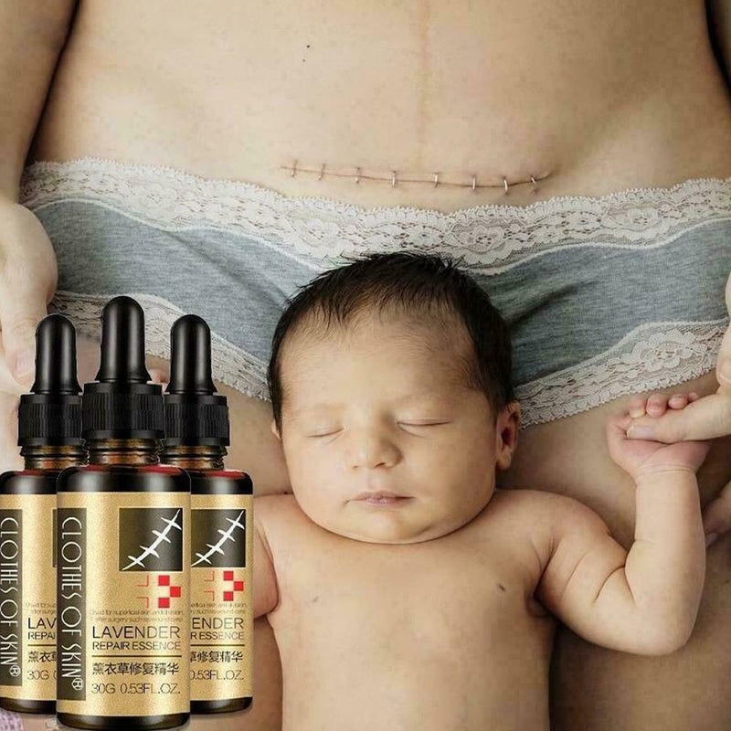 Lavender Essence Skin Care Natural Pure Remove Ance Mark Burn Strentch Remo H0D9