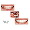 1Pair Teeth Veneers Perfect Smile Cosmetic Snap On Comfort Covers Upper Bottom3C