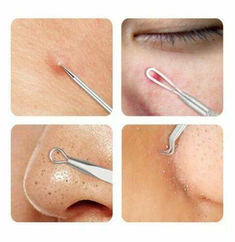 4Pcs Blackhead Whitehead Pimple Spot Comedone Extractor Remover Popper Tools Kit