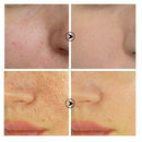 Shrink Pores Essence Serum Blackhead Acne Face Oil Moisturizing Essence