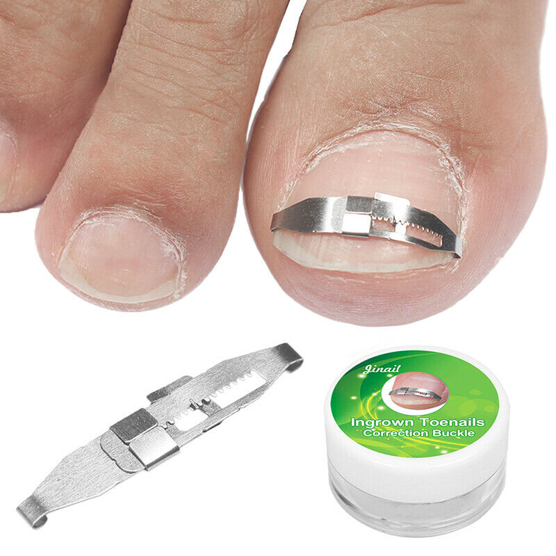 Ingrown Toe Nail Recover Correction Patch Pedicure Toenail Fixer Foot Care T Pg