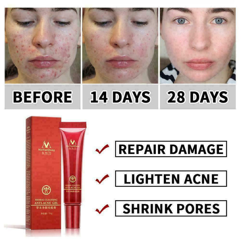 15ml Crema Acne para ELIMINA Barros Manchas Espinillas I8P7 Tu RECUP Piel L U6O8