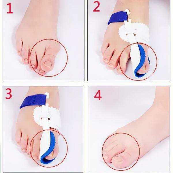 2 x Big Toe Bunion Hallux Valgus Corrector Bunion Splint Separators Straightener