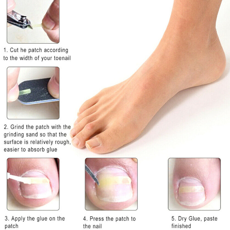 Ingrown Toe Nail Correction Kit Toenail Treatment Nail Pusher Recover Foot C Pg