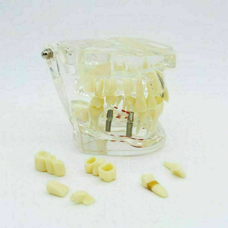 Teeth Restoration Implant Removable Disease Tooth & Teaching Dental Bridge A2X0