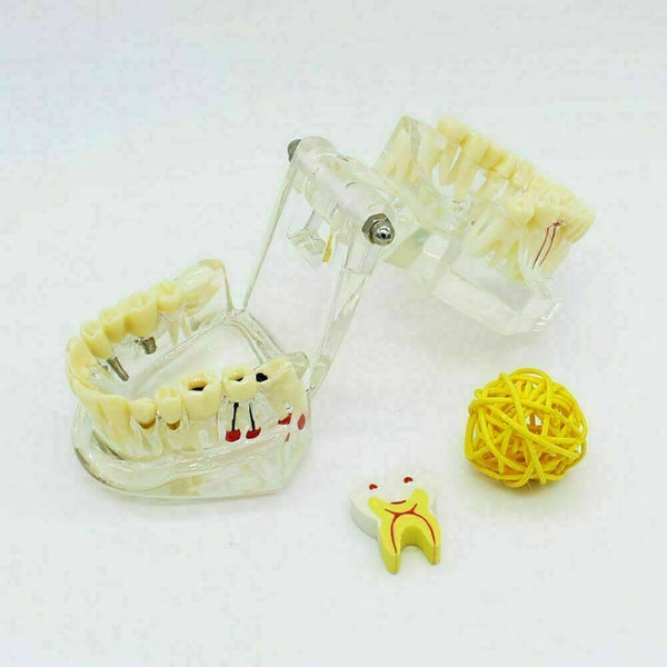 Teeth Restoration Implant Removable Disease Tooth & Teaching Dental Bridge A2X0