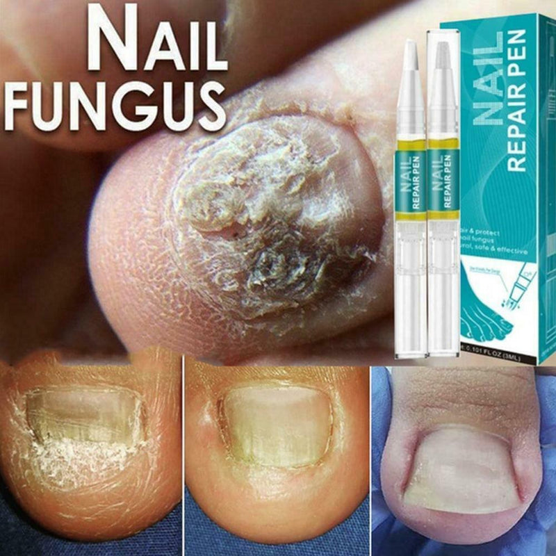 Nail Fungus Repair Treatment Pen Products Onychomycosis Paronychia Anti Fungal