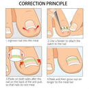 Ingrown Toe Nail Straightening Clip Brace Foot Care Toe Nail Correction Tool