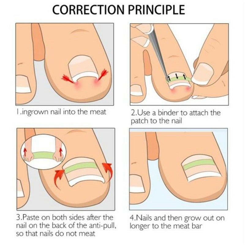 Ingrown Toe Nail Straightening Clip Brace Foot Care Toe Nail Correction Tool