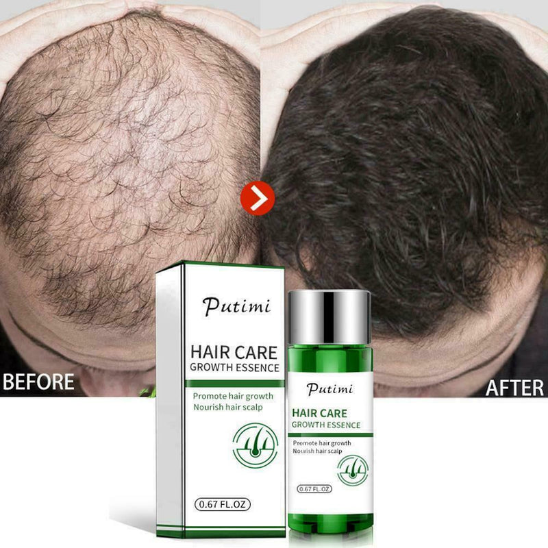 Hair Growth Dense Regrowth Ginger Serum Oil Anti Loss Treatment Essence 20M T1W7