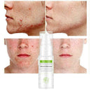 Tree Shrink Pores Oil-control Anti-Acne Essence L0L2 Acne Scar Trea Z8K Z5N C7D8