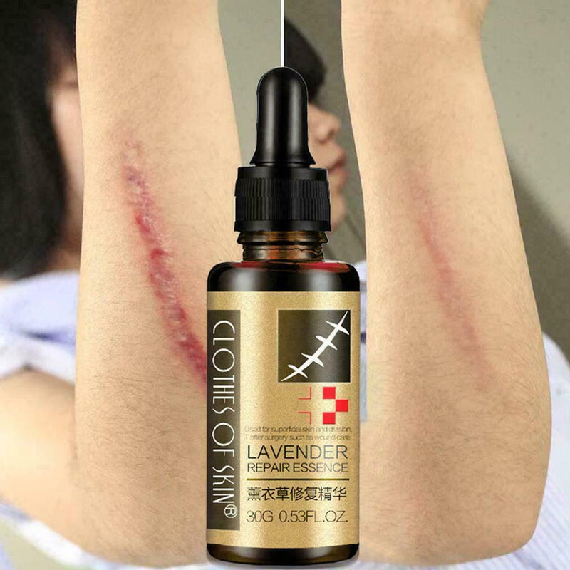 Lavender Essence Skin Care Natural Pure Remove Ance Mark Burn Strentch Remo H0D9