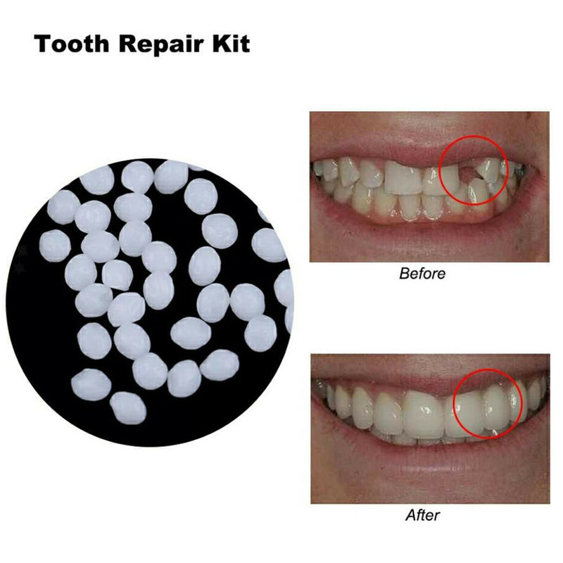 Thermal Beads Temporary Tooth Repair for Fix the Missing Tooth Teaching 50g