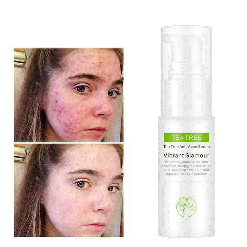 Tree Shrink Pores Oil-control Anti-Acne Essence L0L2 Acne Scar Trea Z8K Z5N C7D8