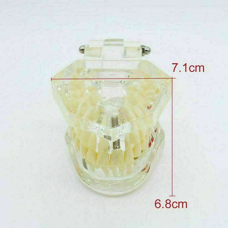 Teeth Restoration Implant Removable Disease Tooth & Teaching Dental Bridge A2X0