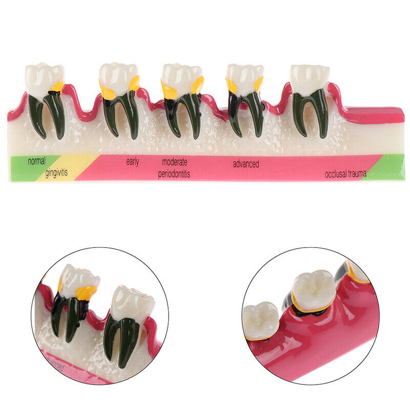 Dental Lab Periodontal Disease Assort Tooth Typodont Study Teaching Teeth ModFT