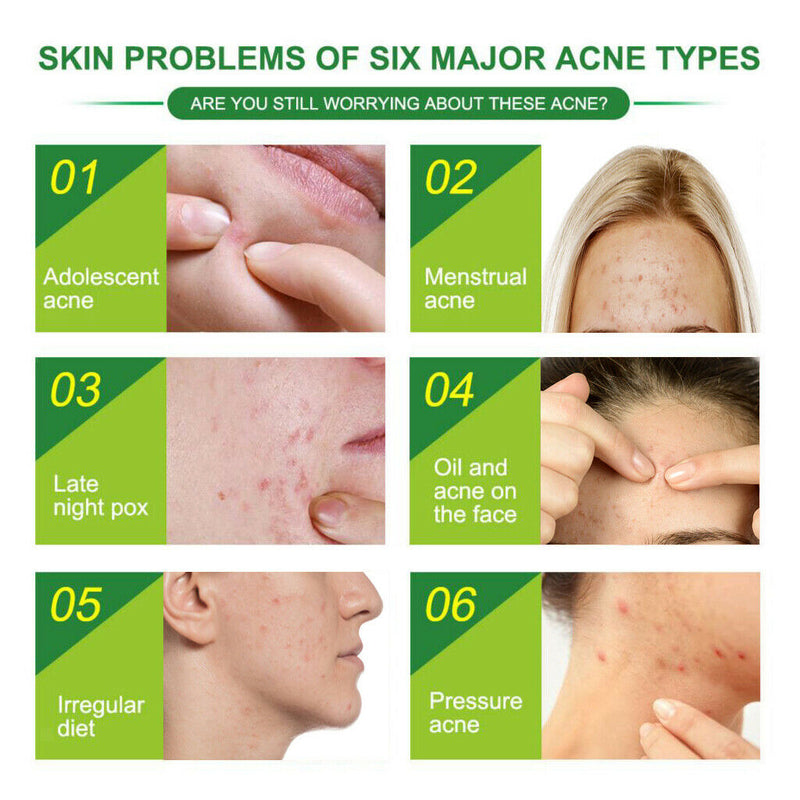 24pcs Acne Stickers Acne Patch Transparent Invisible Remover