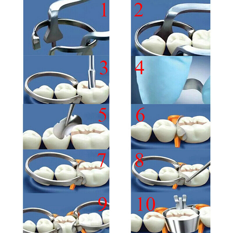 60Pcs Dental Matrix Sectional Contoured Metal Matrices Elastic Wedges SpringSEAU