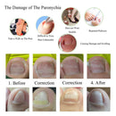 Professional Ingrown Toe Nail Correction Pedicure Toenail Protector Treatment
