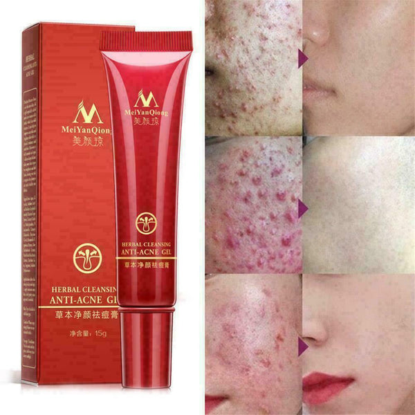 15ml Crema Acne para ELIMINA Barros Manchas Espinillas I8P7 Tu RECUP Piel L U6O8