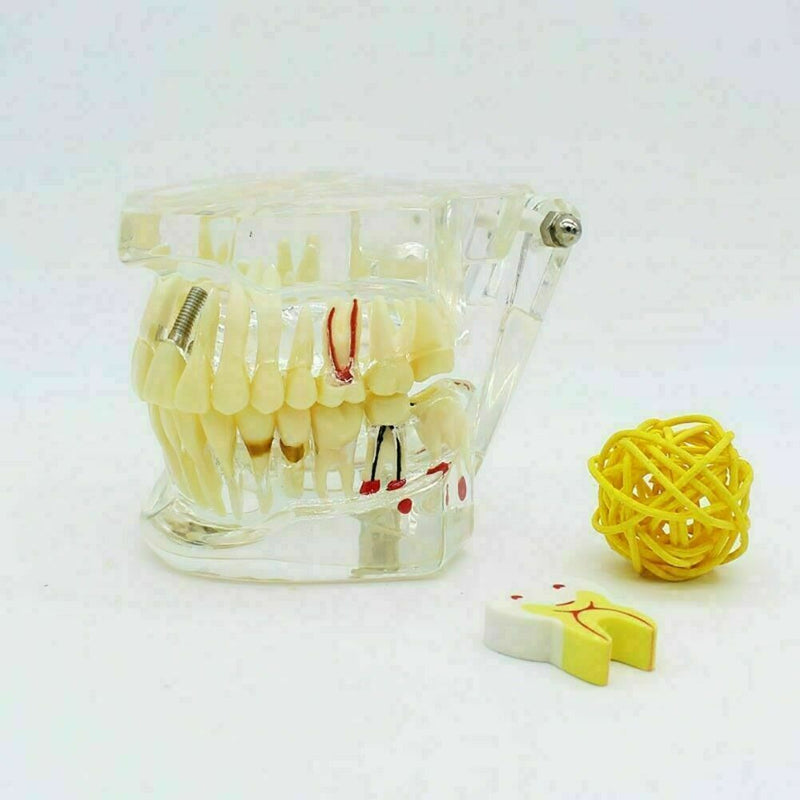 Teeth Restoration Implant Removable Disease Tooth & Teaching Dental Bridge A2X0