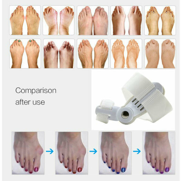 Toe Orthosis Bone Thumb Valgus Orthosis Unisex Day Night Toe Can Wear ShoesS Hn