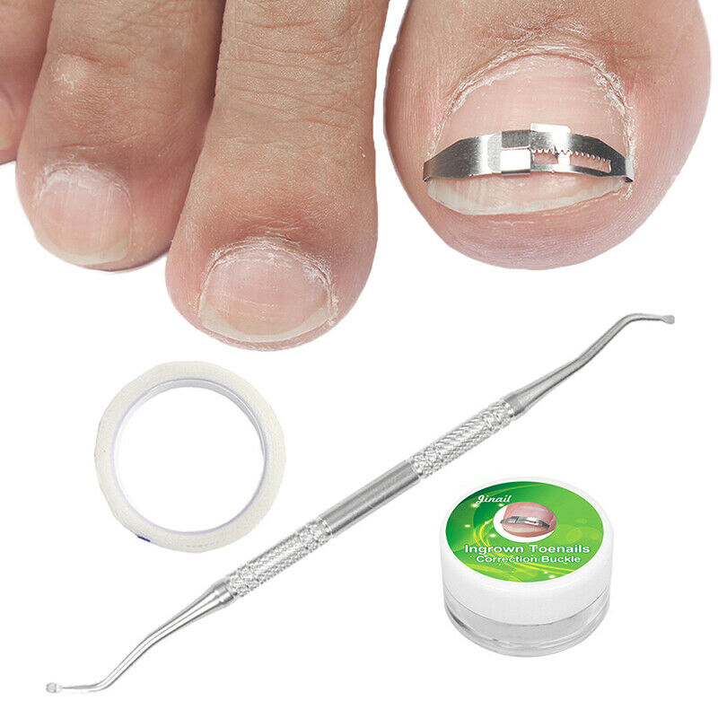 Ingrown Toe Nail Recover Correction Patch Pedicure Toenail Fixer Foot Care T Pg