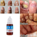 10ml Nail Repair Treatment Liquid Cleanser Onychomycosis Disinfect Water ne O7A1