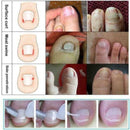 10Pcs Ingrown Toenail Straightening Clip Curved Brace Glue With Kit Correct F2V4