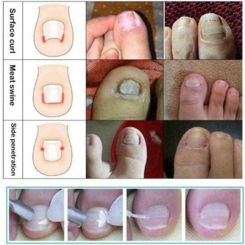 10Pcs Ingrown Toenail Straightening Clip Curved Brace Glue With Kit Correct F2V4