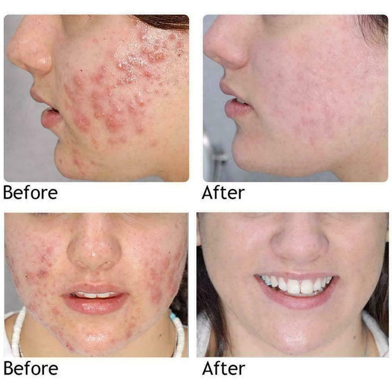 Pure Natural Tree Essential Oil Acne Treatment Face Z Skin Care Z1R9