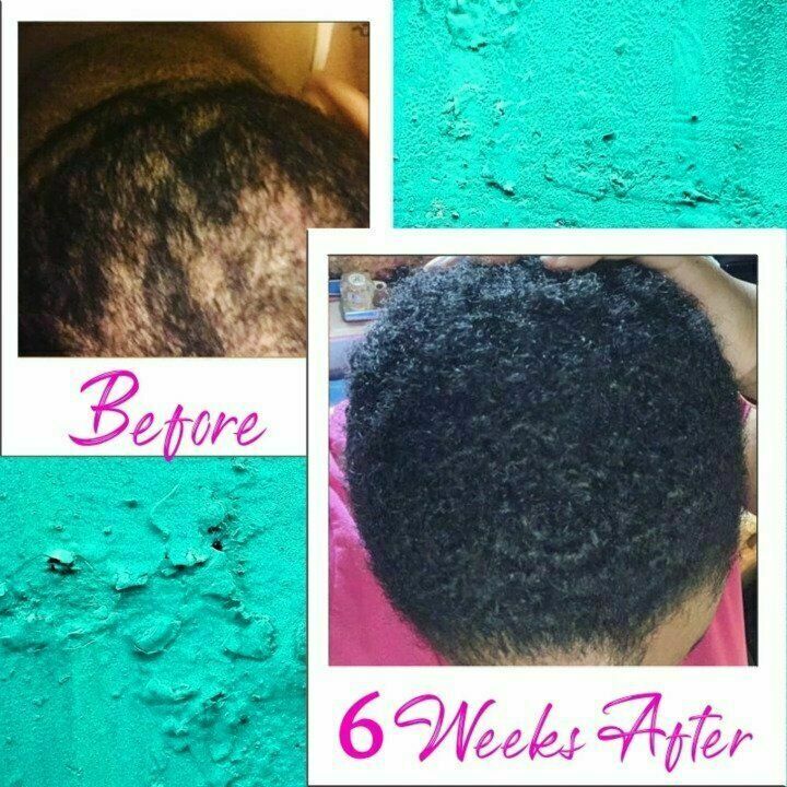 Hair Regrowth Serum Perfect Hair Essential Oil 30ml F6H4