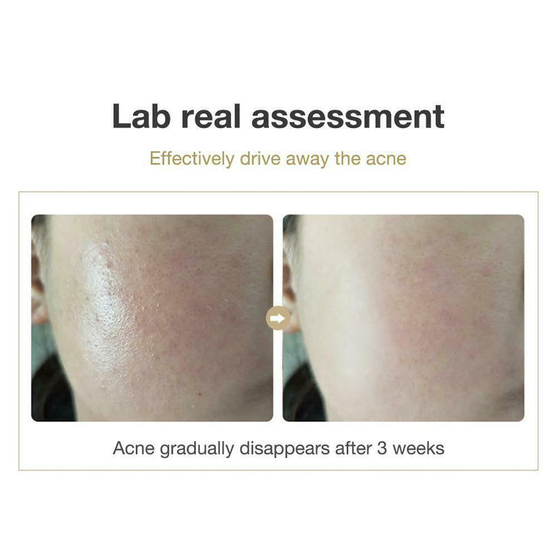 Face Repair Powder Oligopeptide Lyophilized Solution Acne Blood Caps Pore Shrink