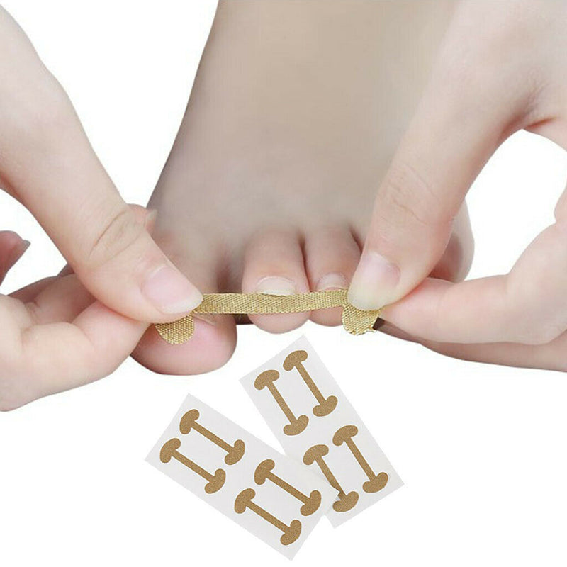 20 Pcs Ingrown Nail Correction Stickers Toenail  Brace Foot Care