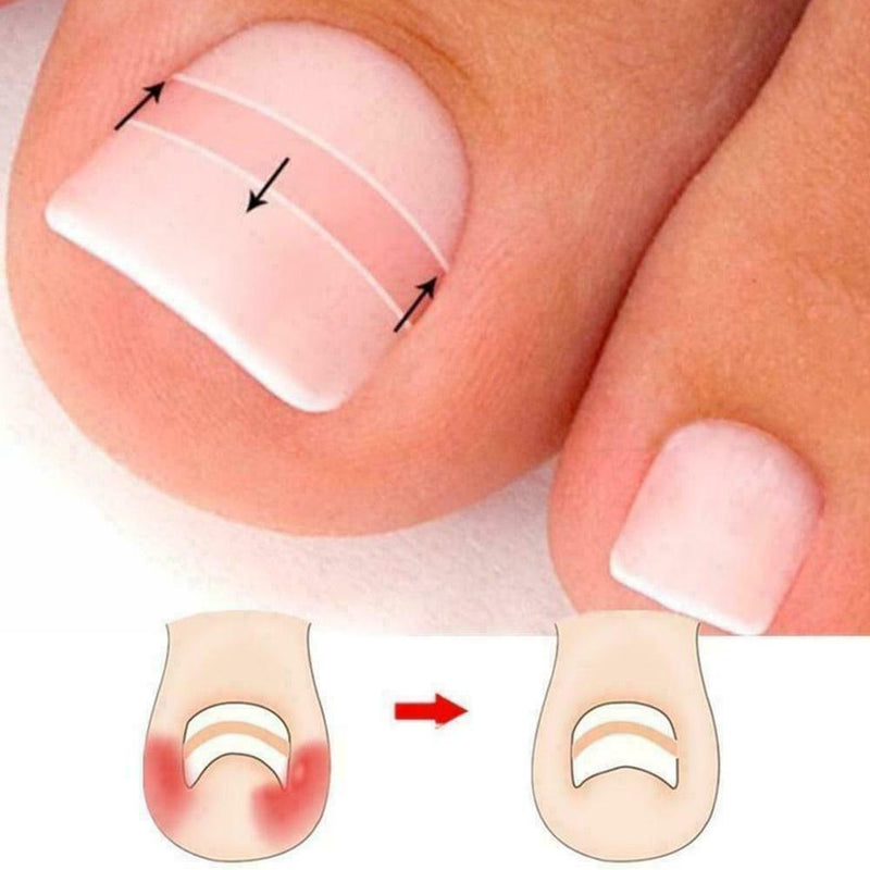 10Pcs Ingrown Toenail Straightening Clip Curved Brace Glue With Kit Correct F2V4