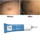 Universal Silicone Scar Remover Removal Serum Face Skin Burns Repair U2R1